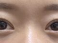 การผ่าตัดทำตาสองชั้น + การดูแลใต้ตา: รีวิวหลัง 2 เดือน