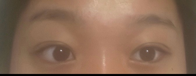 术后