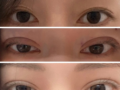 รีวิวการปลูกถ่ายไขมันเปลือกตาด้วยเทคนิคยึดเกาะธรรมชาติ First Su