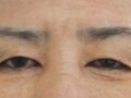 3 เดือนหลังการผ่าตัดเปลือกตาบน