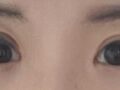 ผู้กำกับ คิม ฮงจิน / ศัลยกรรมตกแต่งเปลือกตาสองชั้น
