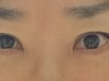 双眼皮+下眼睑   术后2个月 