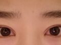 全切双眼皮 修复  术后2个月反馈  (都彦禄院长)