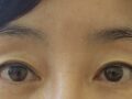 成功的双眼皮修复
