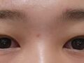 รีวิวการผ่าตัดทำตาสองชั้นแบบกรีด + การแก้ไขเปลือกตา