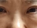都彦禄院长- 眼底脂肪重排  术后反馈