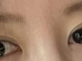 การผ่าตัดแก้ไขดวงตา (การกรีด)
