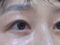 การผ่าตัดตา + การปลูกถ่ายและกระจายไขมันของผู้อำนวยการโด ออน-ร็อก
