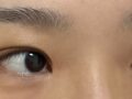 都彦禄院长  双眼皮修复 术后反馈