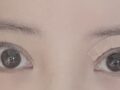 แผลผ่าตัดแก้ไขตาสองชั้น