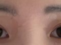 都彦禄院长  双眼皮修复  术后反馈