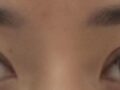 双眼皮修复  术后反馈