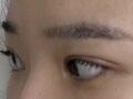 第四次双眼皮修复手术 找的都彦禄院长