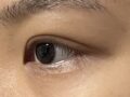都彦禄院长  埋线双眼皮+上眼角