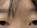 รีวิวการแก้ไขเปลือกตาโดยไม่ต้องผ่าตัด
