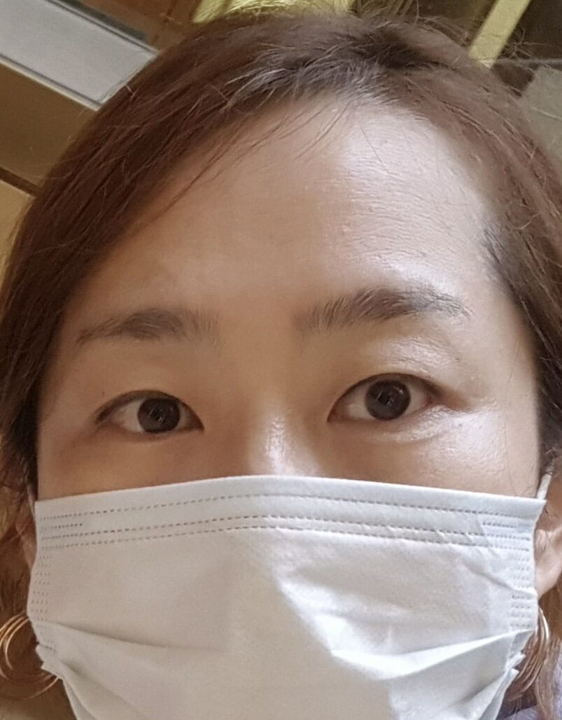ドアンロック院長目整形2ヶ月後期