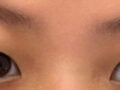 รีวิวการผ่าตัดแก้ไขดวงตาของ ดร. โด ออน-รก: การยึดติดแบบธรรมชาติ + การแก้ไขเปลือกตา