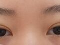 รีวิวการผ่าตัดทำตาสองชั้นของ ดร. คิม ฮงจิน