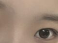 ศัลยกรรมตกแต่งเปลือกตาสองชั้น