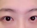 นี่คือรีวิวเกี่ยวกับการผ่าตัดแก้ไขเปลือกตาแบบกรีดบางส่วนที่ฉันได้รับจากผู้อำนวยการโด ออน-รก ที่คลินิกอิลมิริ