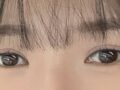 都彦禄院长    双眼皮修复  