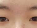การผ่าตัดทำตาสองชั้นด้วยแผลขนาด 1 มม.: รีวิวหลังผ่าตัด 2.5 เดือน