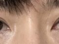 การแก้ไขและผ่าตัดเปลือกตา 1 มม.