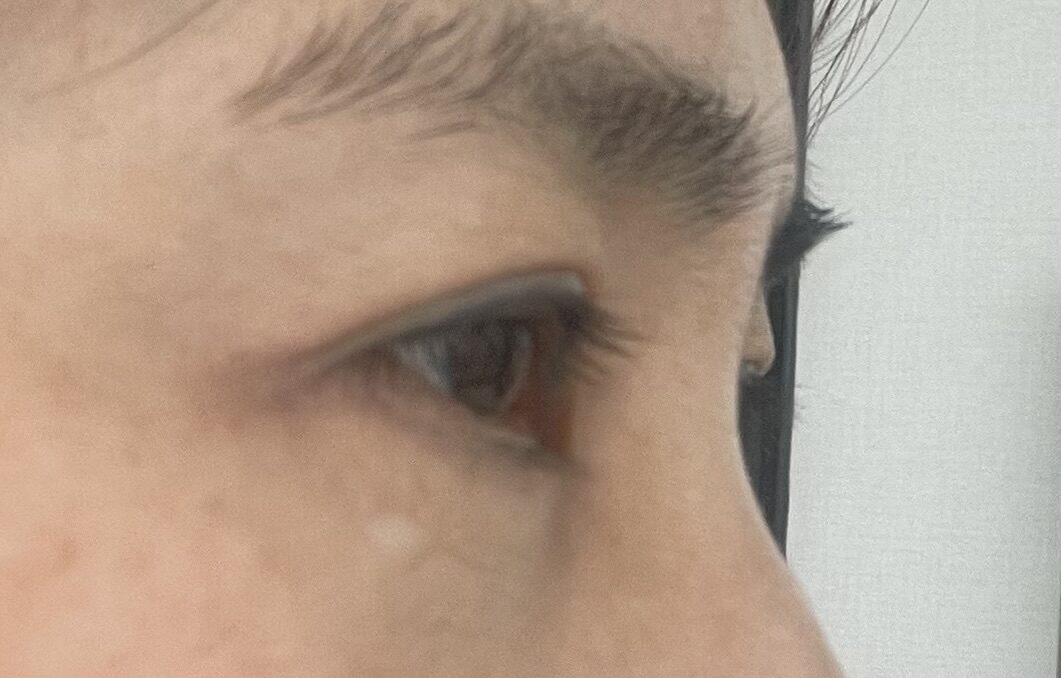 イルミリハアン剣手術