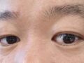 术后2个月复查