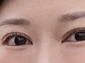 一毫米 双眼皮修复 术后反馈