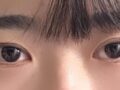 ศัลยกรรมตกแต่งเปลือกตาแบบไม่ต้องกรีดของ นา ยองซู ผู้อำนวยการอิลมิริ