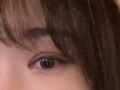 รีวิวผลงานของ ดร. โด ออน-รก ที่คลินิกอิลมิริ: การยกกระชับเปลือกตาบนแบบไม่กรีด
