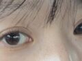 การผ่าตัดแก้ไขเปลือกตาโดย ดร.โด ออน-รก: การแก้ไขเปลือกตาด้วยการยึดติดแบบธรรมชาติ - รีวิว 3 เดือน