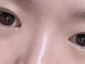 รีวิวหลังการผ่าตัดแก้ไขเปลือกตาด้วยวิธี Natural Adhesion กับคุณหมอ Do Eon-rok ที่ Ilmiri ครบ 3 เดือน