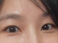 1毫米 在金洪振院长这里做了双眼皮修复  反馈