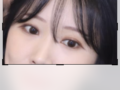 ペアカップル切開再手術後期