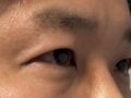 イルミリ+キム・ホンジン院長+目つき矯正&フロントトイム