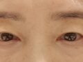 切眉提升 术后反馈