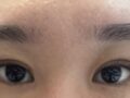 全切双眼皮修复