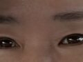 中年 眼部手术