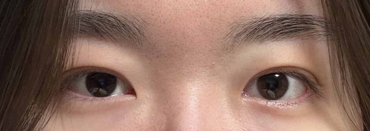 术后