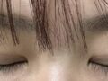二重まぶた切開後期