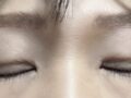 自然癒着+ウィットイム+眉毛状