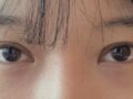 目元形成術
