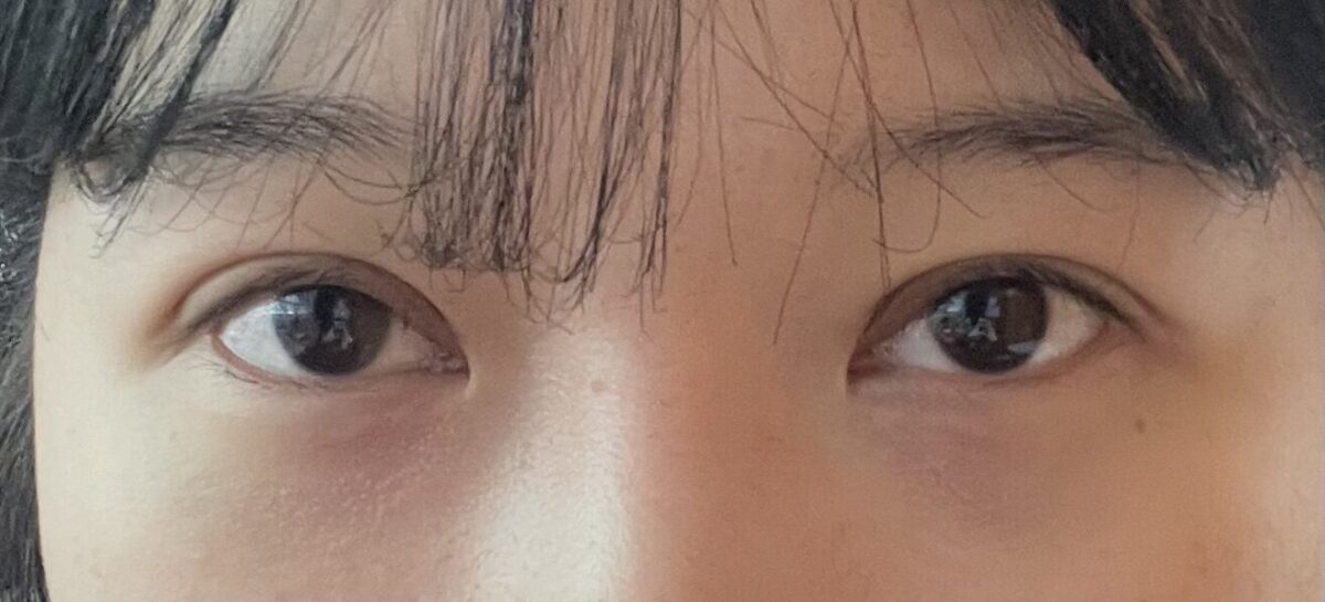การผ่าตัดตา