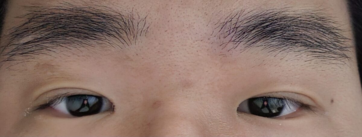 รีวิวการแก้ไขเปลือกตาโดยไม่ต้องผ่าตัด