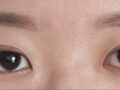 ฉันได้รับการรักษาโดยไม่ผ่าตัดจากผู้อำนวยการโด ออน-รก