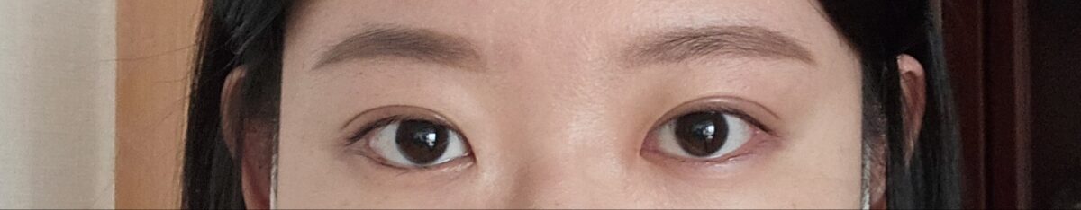 ฉันได้รับการรักษาโดยไม่ผ่าตัดจากผู้อำนวยการโด ออน-รก