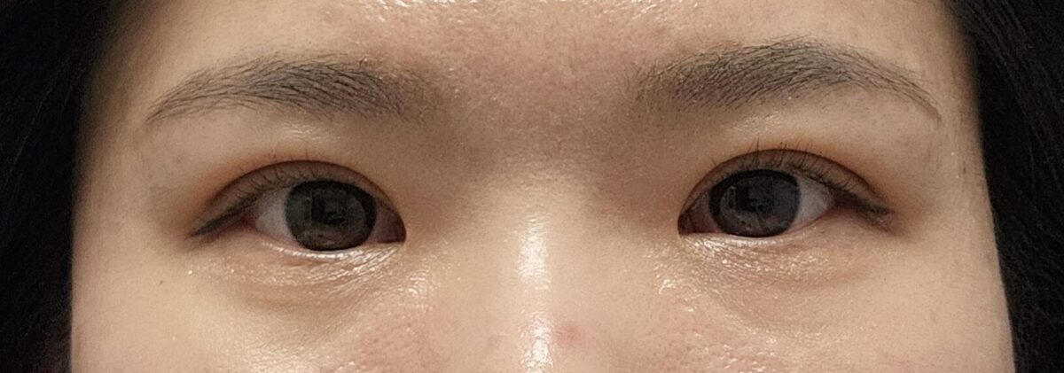 รีวิวการยกกระชับเปลือกตาบนแบบไม่ผ่าตัดด้วยวิธีธรรมชาติ