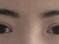 การผ่าตัดแก้ไขดวงตา (การยึดติดตามธรรมชาติ)